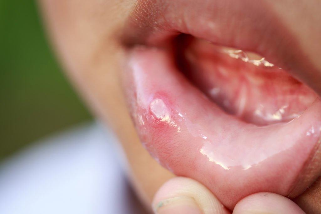 Oral Aid Gel là thuốc gì? Công dụng, liều dùng